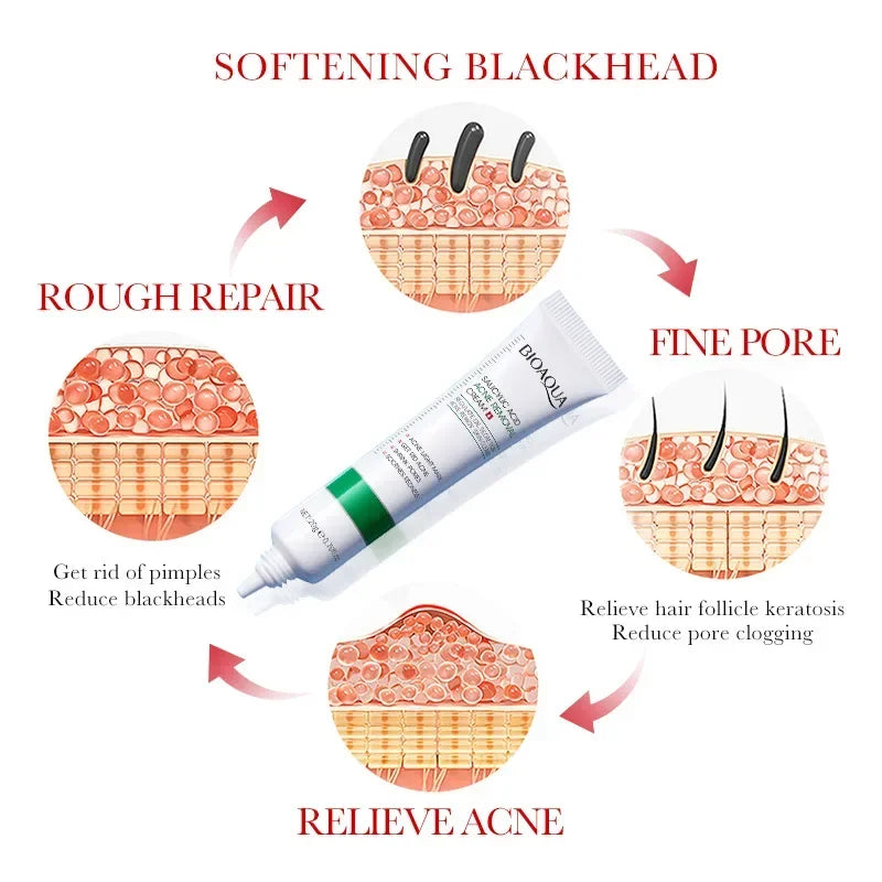 Salicylic Acid Acne Removal Face Cream